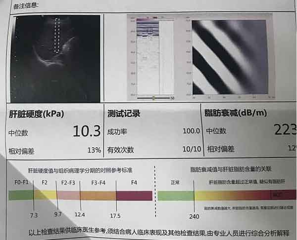 郑州哪儿肝病医院治疗肝硬化效果好