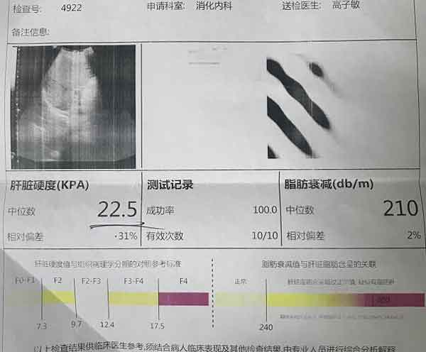 郑州哪儿肝病医院治疗肝硬化效果好