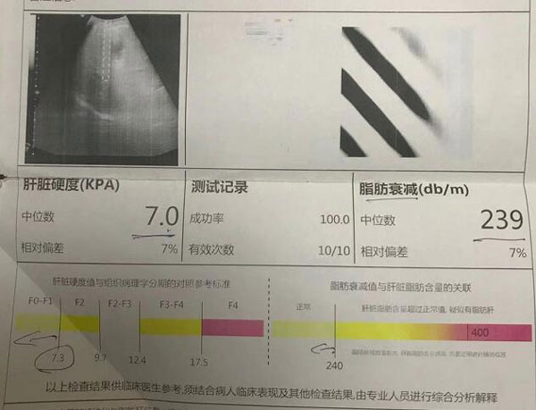 郑州哪里的肝硬化科医院好